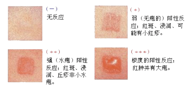 皮肤斑贴试验02皮肤点刺试验可立刻知道检验结果.