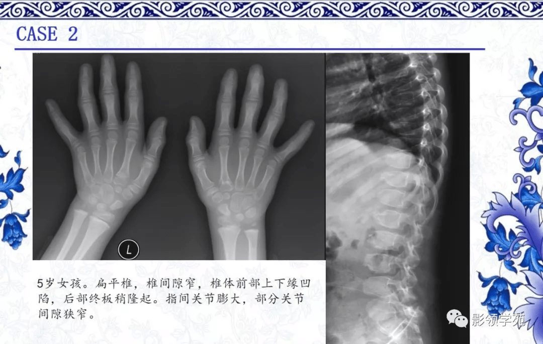 7种常见的骨软骨发育异常x线表现