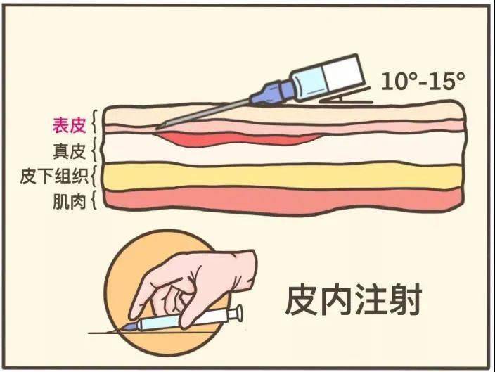 请回想一下打青霉素前做的「皮试」,你将迅速理解这种打法的痛.