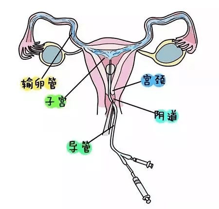 输卵管堵了怎么办?做造影检查痛不痛?