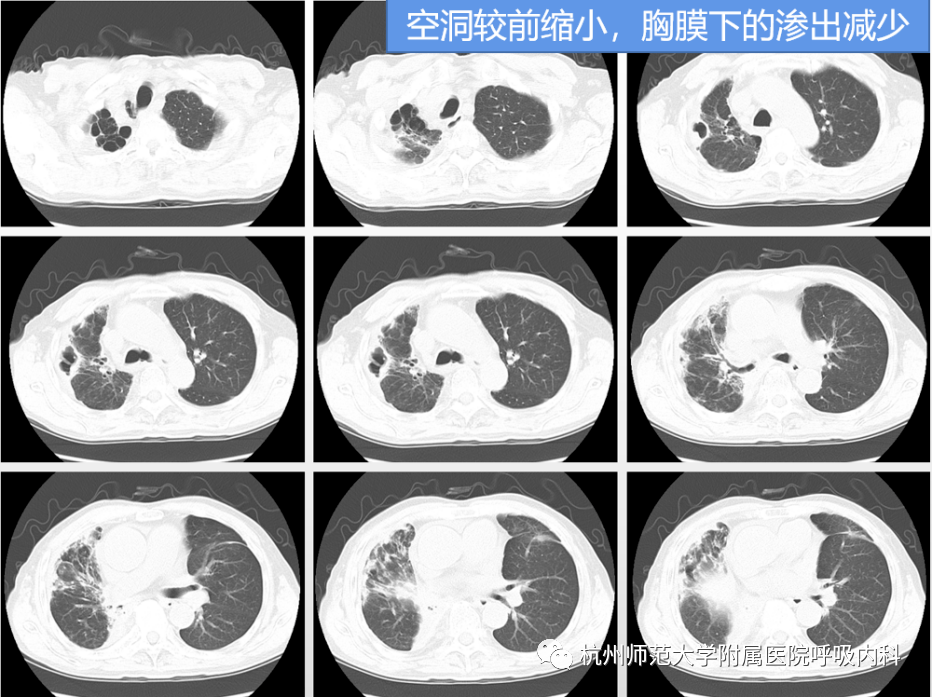 这个"肺空洞"不简单,始作俑者竟是它