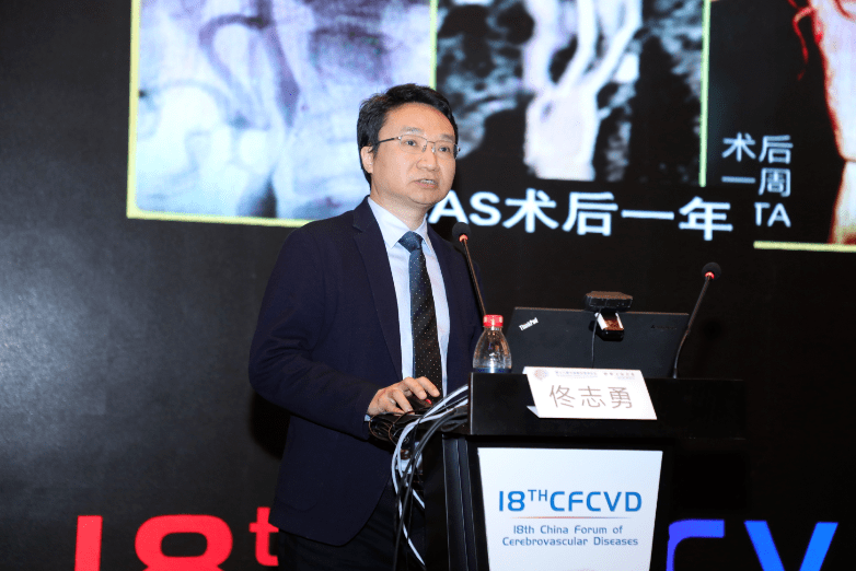 cfcvd2021精华速递颈动脉狭窄专题