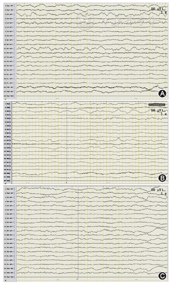 癫痫伴有缺口节律癫痫患者的临床和脑电图研究