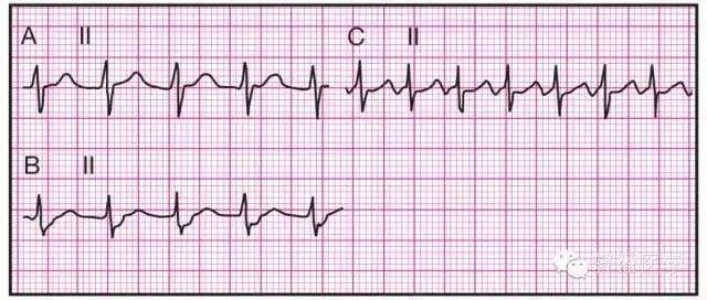 体表心电图具有"锯齿状"特点,f波常在ii, iii 和avf中出现  房室比例