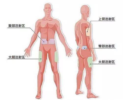 注射胰岛素部位很重要