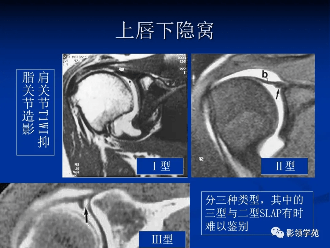 肩关节盂唇损伤的mri诊断