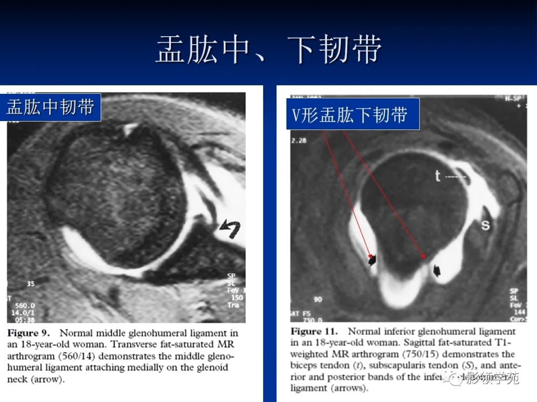 肩关节盂唇损伤的mri诊断