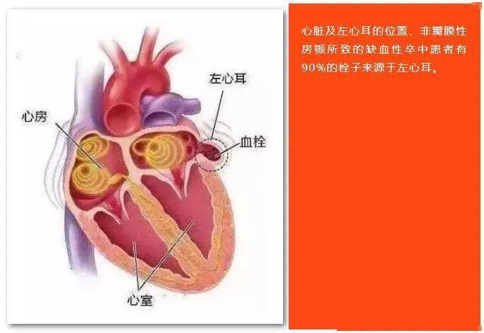 含山东首例淄博市中心医院西院心血管内科二病区完成多例房颤患者左心