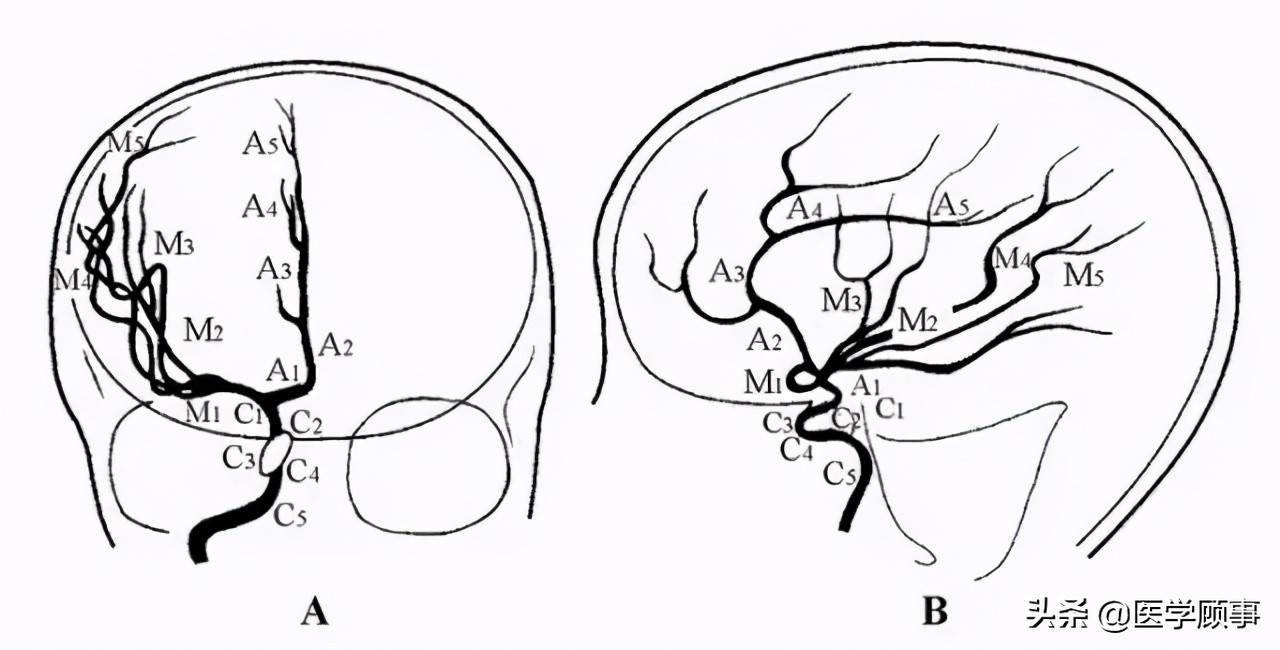 颈内动脉示意图(大脑前动脉和大脑中动脉的分段正,侧位示意图)