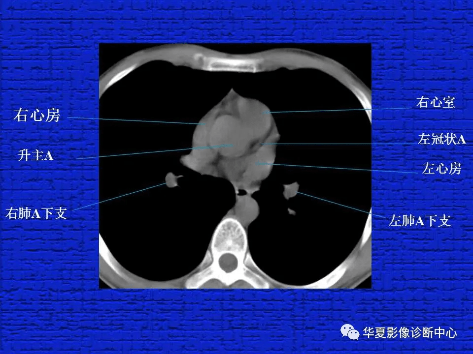 ct入门结合解剖谈正常胸部ct读片