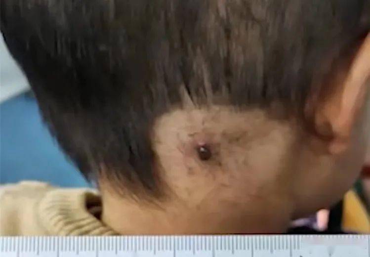 【安全这根弦儿】辽宁2岁男孩出门玩耍,被蜱虫吸血5天
