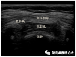 短轴切面,蛙眼征长轴切面,楼梯征骶裂孔顶点前后径 1.