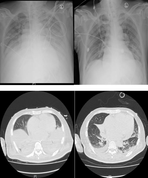 治疗前后患者的胸片和肺部ct对比图