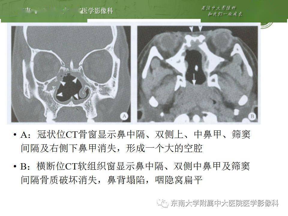 鼻窦解剖及真菌性鼻窦炎影像诊断与鉴别