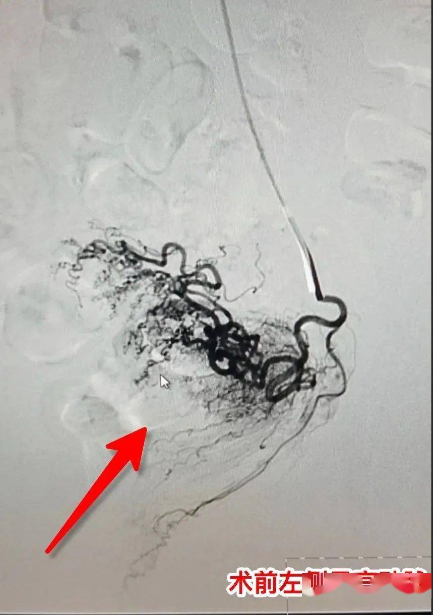 【介入导管室】"子宫动脉栓塞术"不只能治疗宫颈妊娠