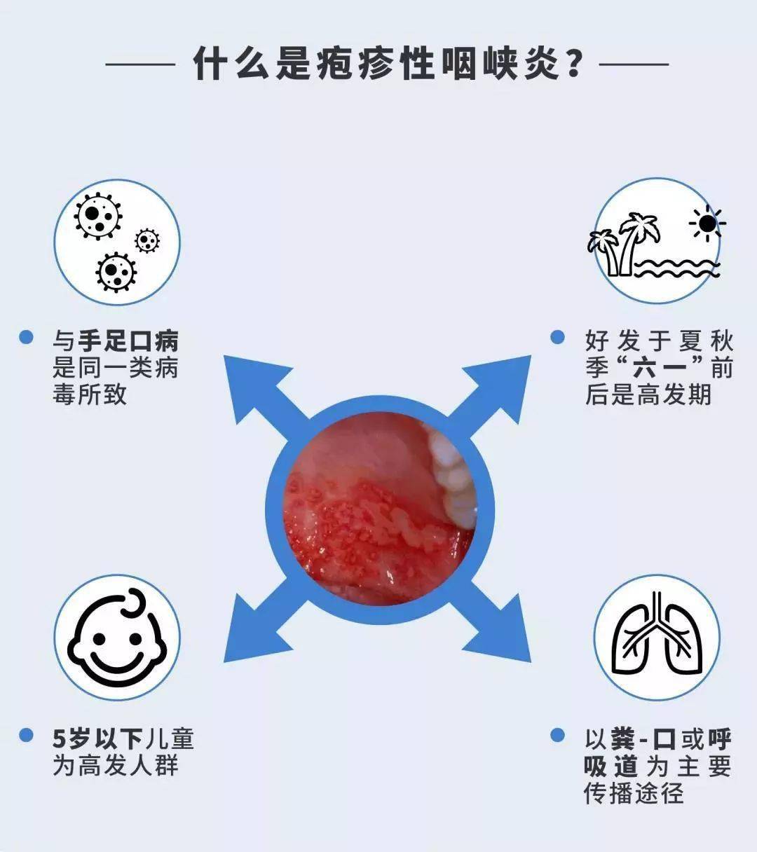 疱疹性咽峡炎最近很猛!主要侵犯1～7岁小儿