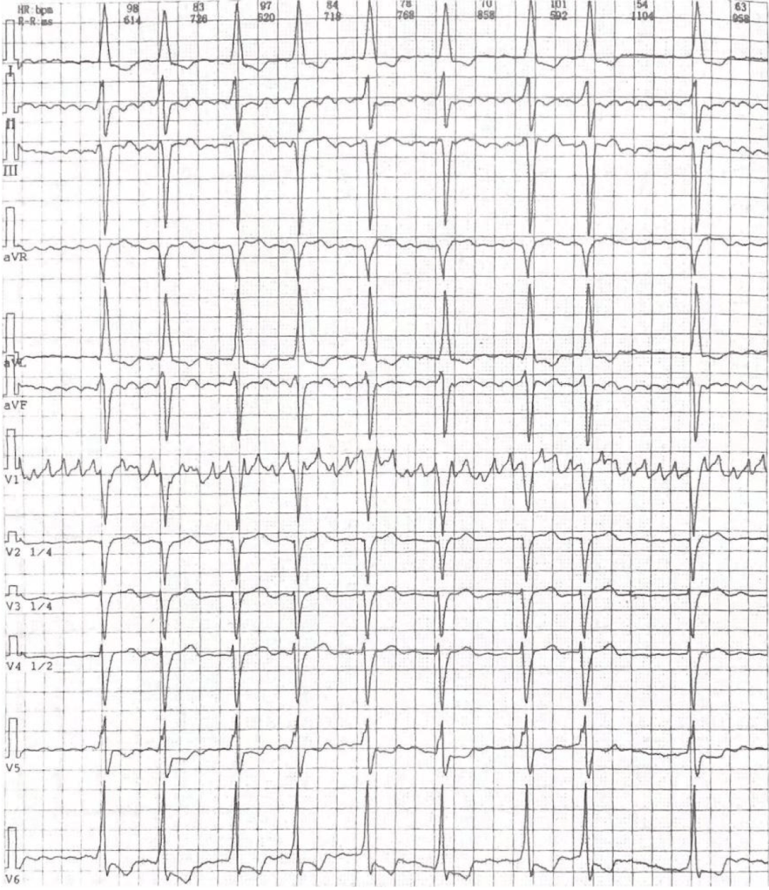 1. b 型预激综合征合并心房颤动心电图