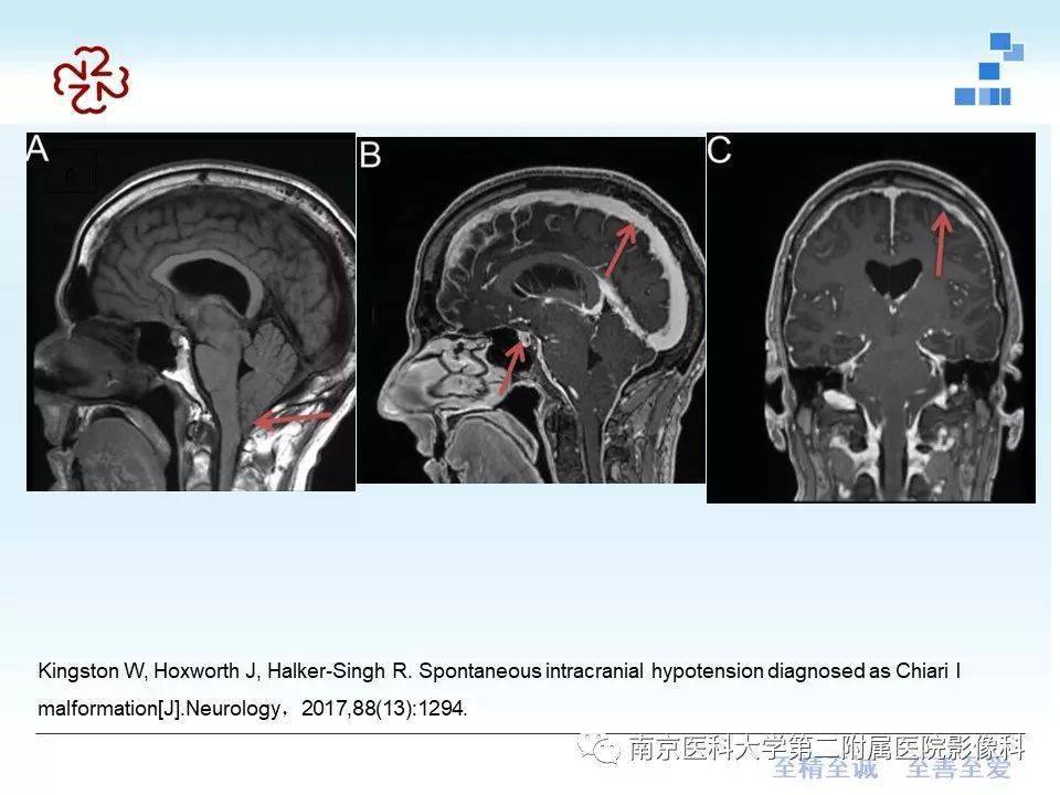 小脑扁桃体下疝畸形