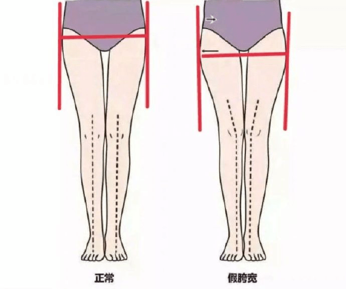 在大腿根部,看上去臀塌腿短  ③  混合型假胯宽:大转子突出 脂肪堆积