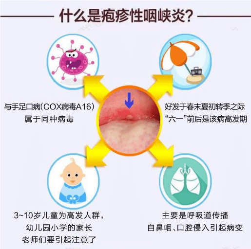 近期,随着气温升高 一种类似于手足口病的疾病: 儿童疱疹性咽峡炎