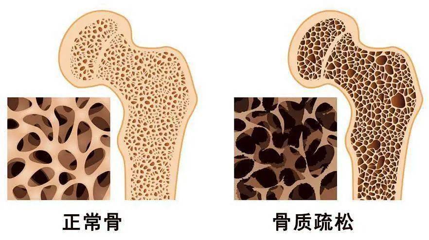 在30岁以前,人体成骨细胞的活性明显强于破骨细胞,骨形成大于骨丢失