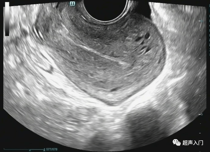 平位子宫(经阴道纵轴切面) 后位:整个子宫沿纵轴向后移动,子宫体在