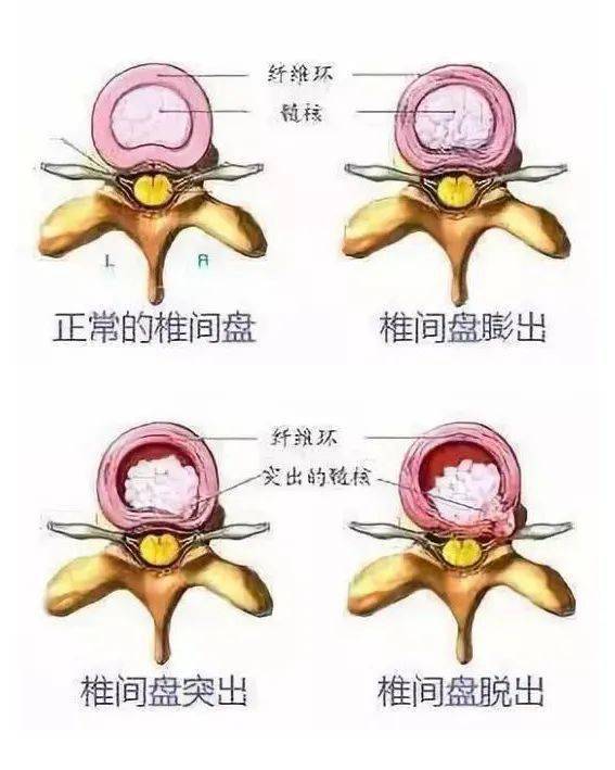 仅仅是椎间盘膨大而已,这种情况就是椎间盘膨出;如果果酱面包继续受压