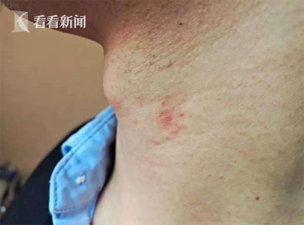 男子醒来发现自己脖子上多了"草莓印" 女友:分手