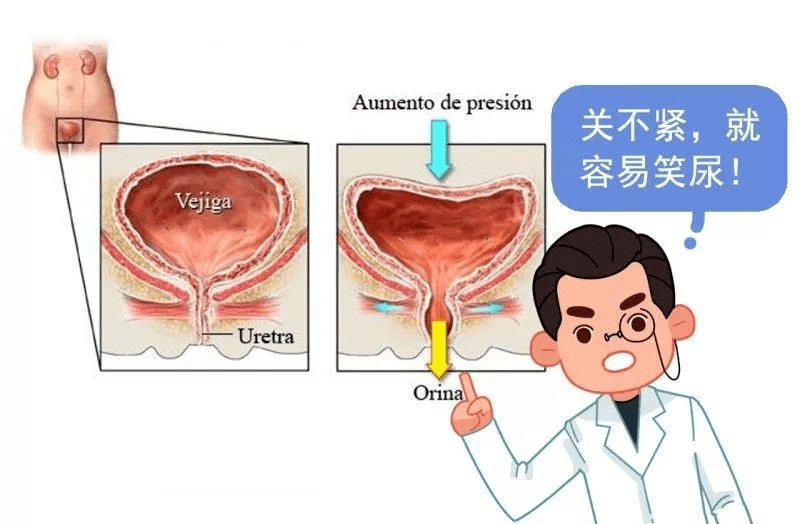 喷嚏,咳嗽的时候,尿液就会从膀胱经尿道溢出,形成"尿失禁"的现象