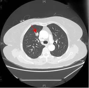 ct显示右肺肿瘤