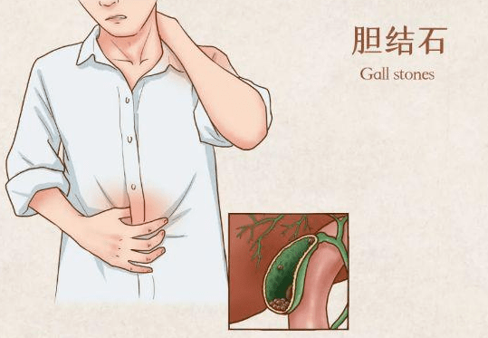 浙江15岁男孩每天炸鸡不断胆囊长满密密麻麻的结石图片慎点