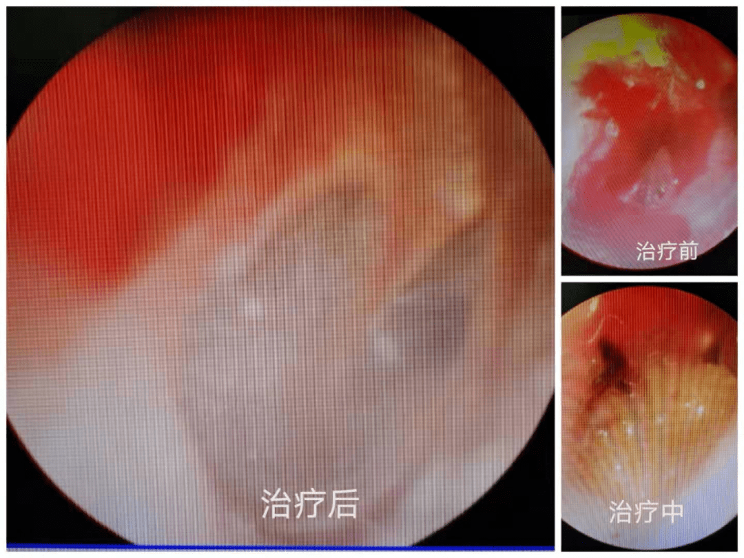 【三医科普】挖耳朵时不小心,导致鼓膜穿孔!