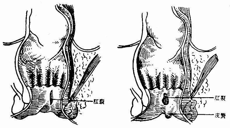肛裂—痛苦的难言之隐_症状