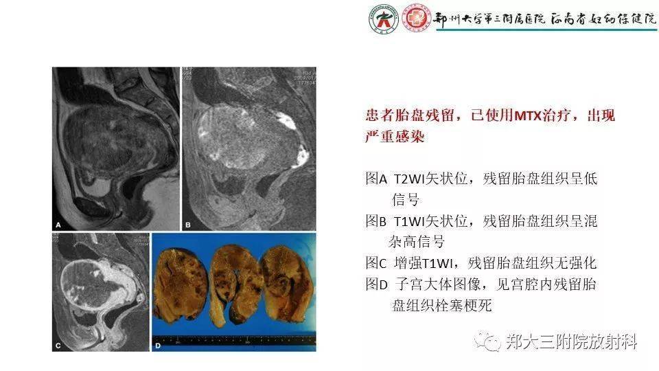 产后胎盘残留的mri影像表现_解剖图