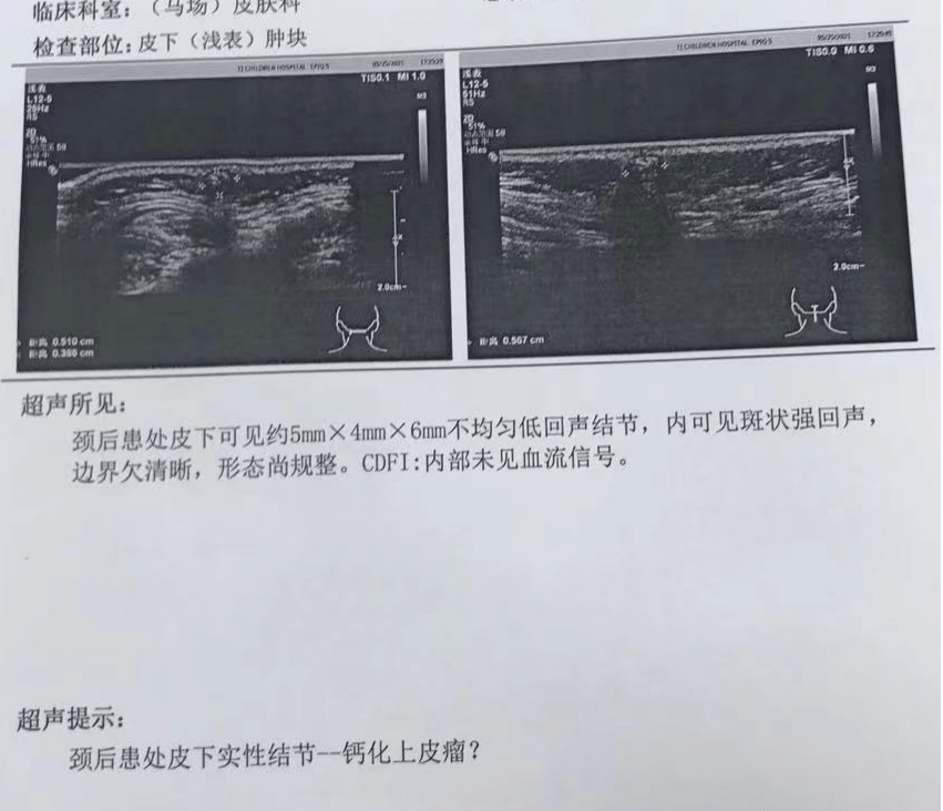 钙化上皮瘤,又名毛母质瘤,是由原始上皮胚芽细胞分化为毛母质细胞