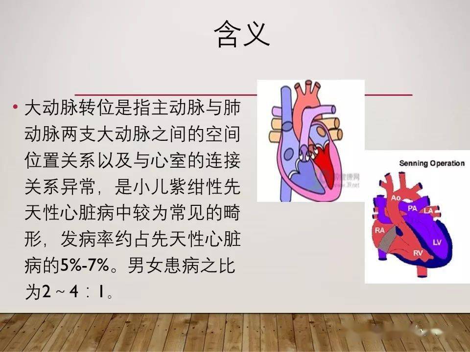 ppt大动脉转位tga的护理