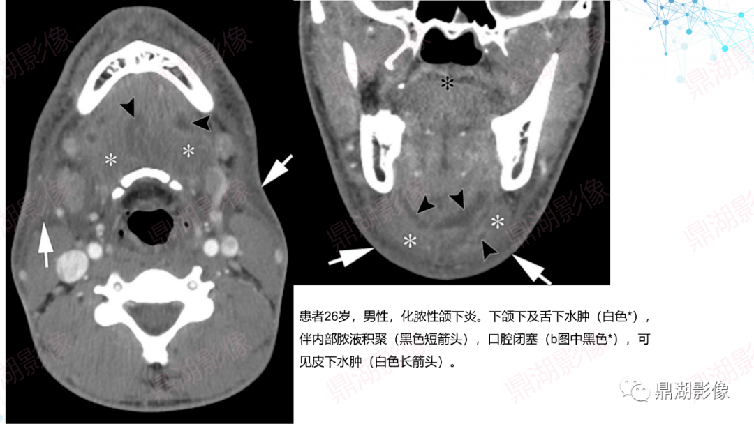 牙周脓肿牙源性鼻窦炎颈长肌钙化性肌腱炎扁桃体炎影像表现会厌炎