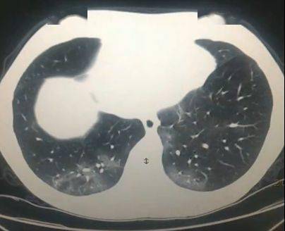 看看如何利用dr做断层诊断新冠肺炎_阴影