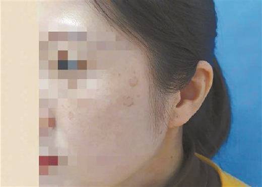 90后女子熬夜10年熬出老年斑?