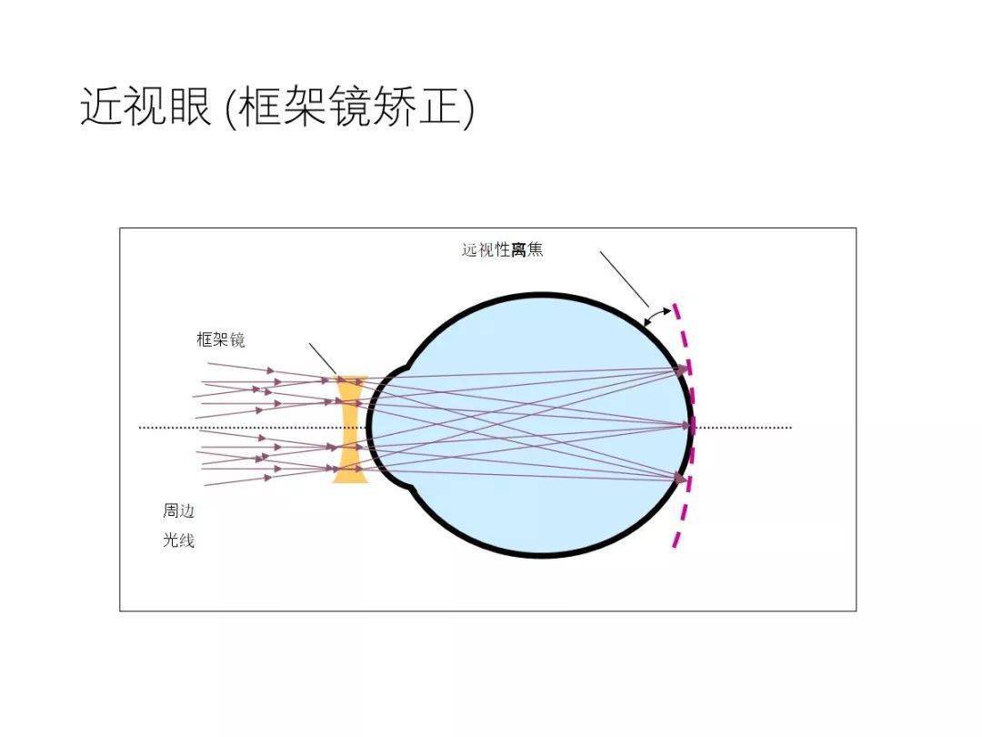 【眼视光】 角膜塑形镜延缓近视发展原理_成像