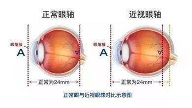 04按压眼球可以控制眼轴增长?