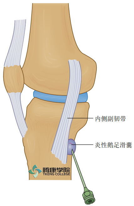 如果膝关节内侧受到创伤时常常累及内侧副韧带.  .