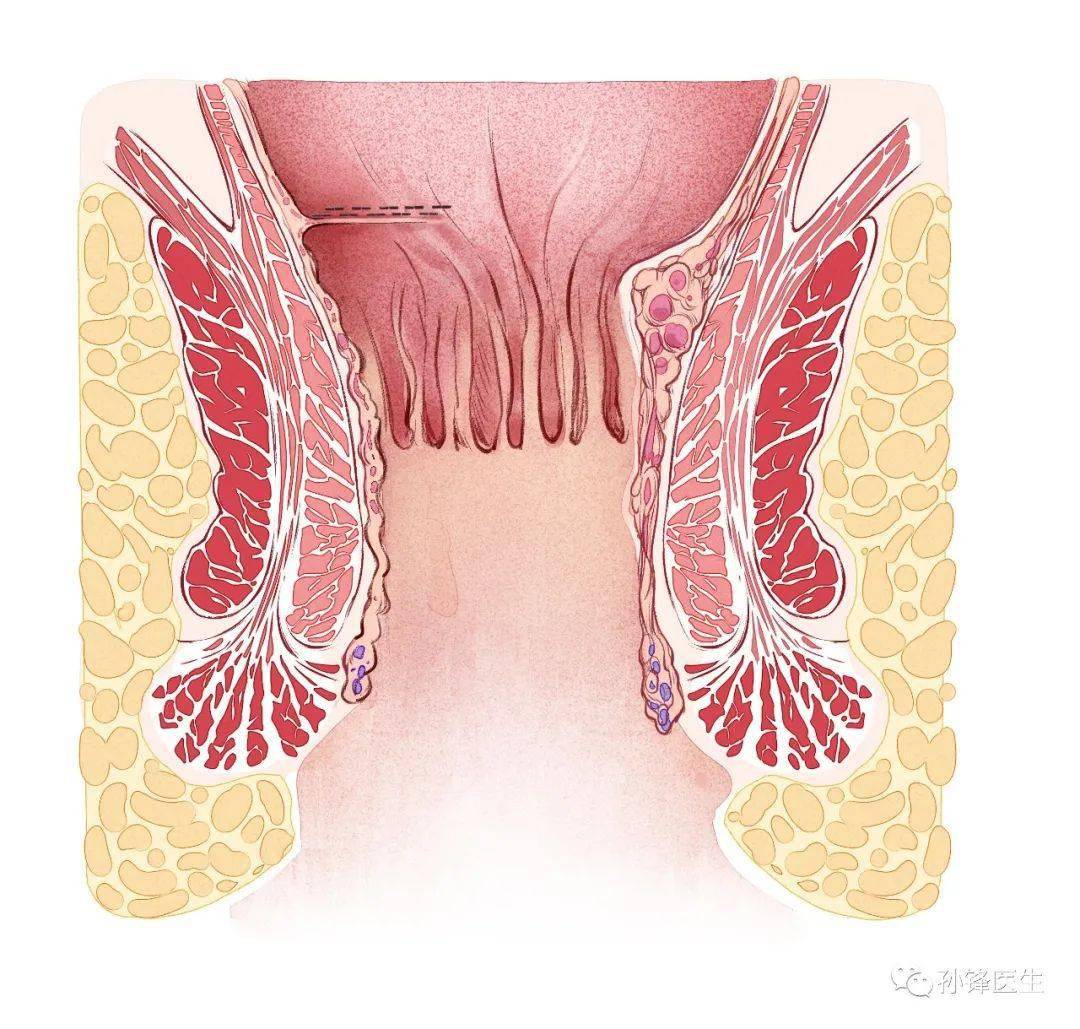 手术笔记痔的星月术弧形直肠粘膜环切术痔动脉结扎术