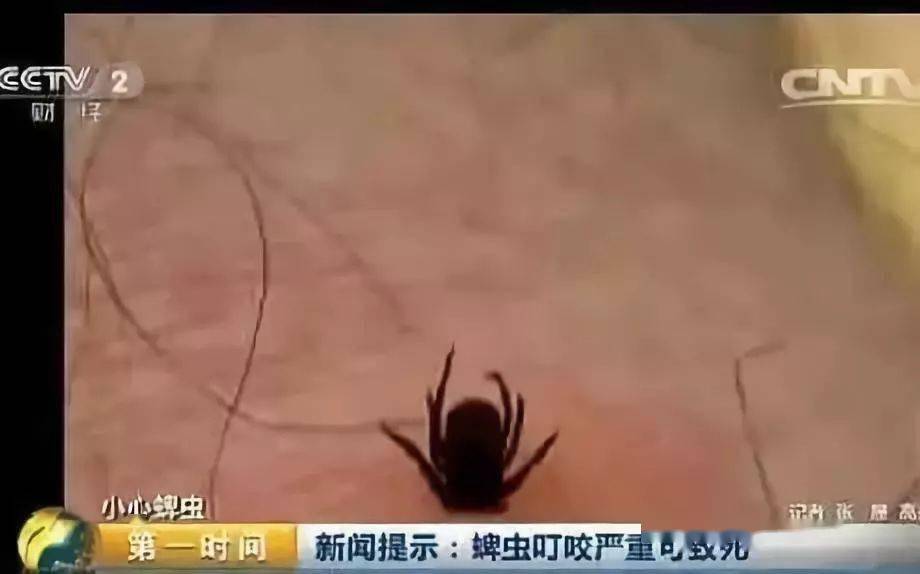 虽然绝大多数蜱虫咬伤患者,经过妥善处理后,一般不会有后遗症,但也不