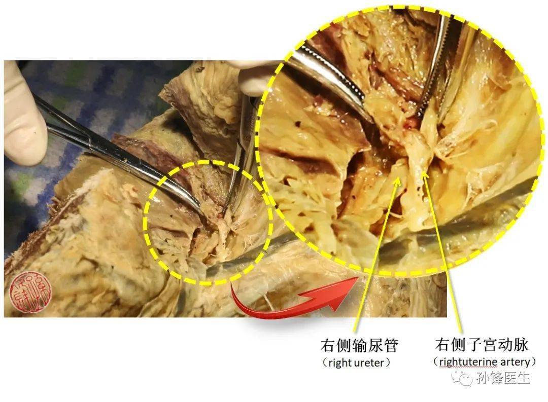 图(14):右侧子宫动脉与右侧输尿管的交叉↑↑↑女性输尿管盆部与子宫