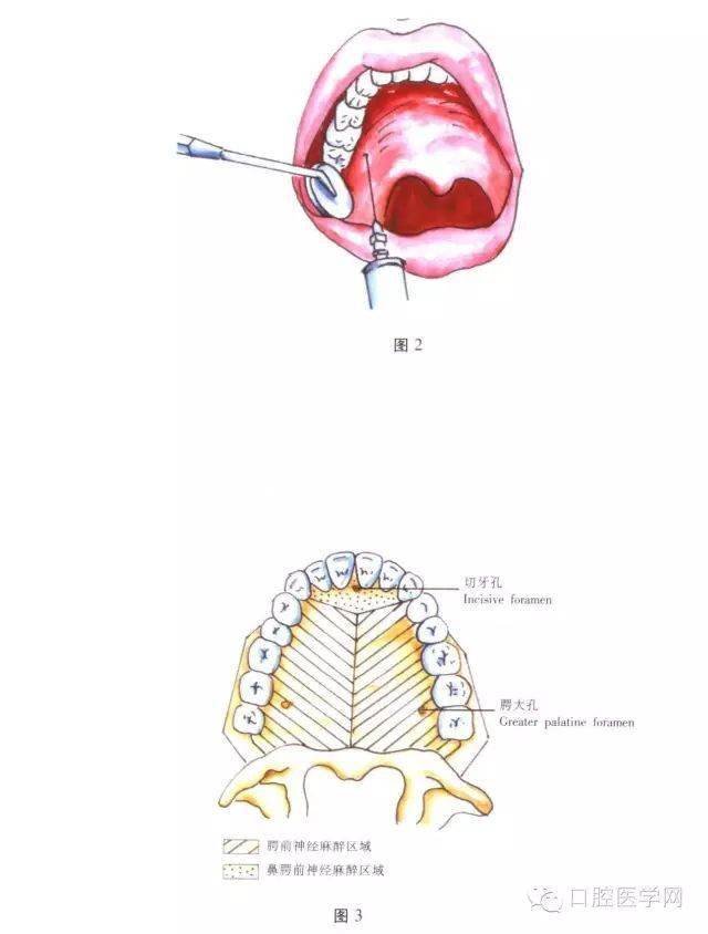 进针点:注射针自对侧口角向患侧腭大孔黏膜表面标志稍前内方为刺入点