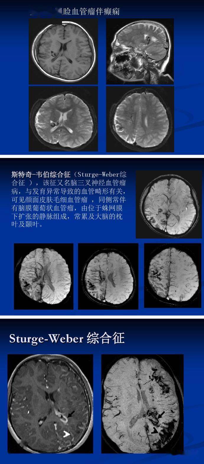磁敏感加权成像(swi)详细临床应用_解剖图