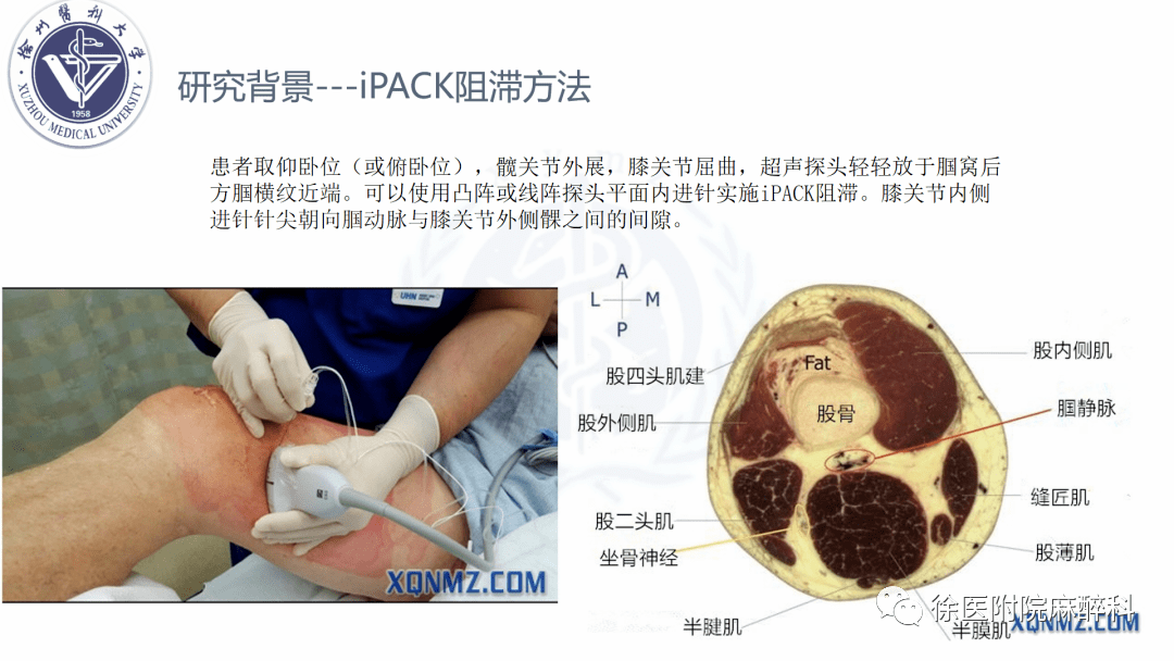 全膝关节置换术中局部浸润麻醉和连续收肌管阻滞结合i