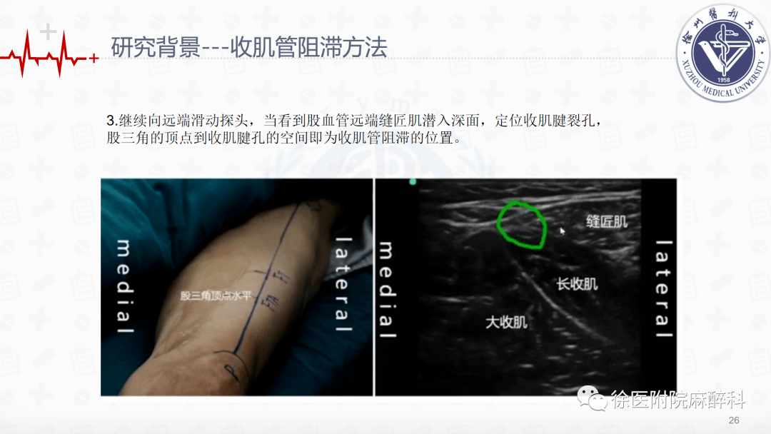 全膝关节置换术中局部浸润麻醉和连续收肌管阻滞结合ipack神经阻滞的