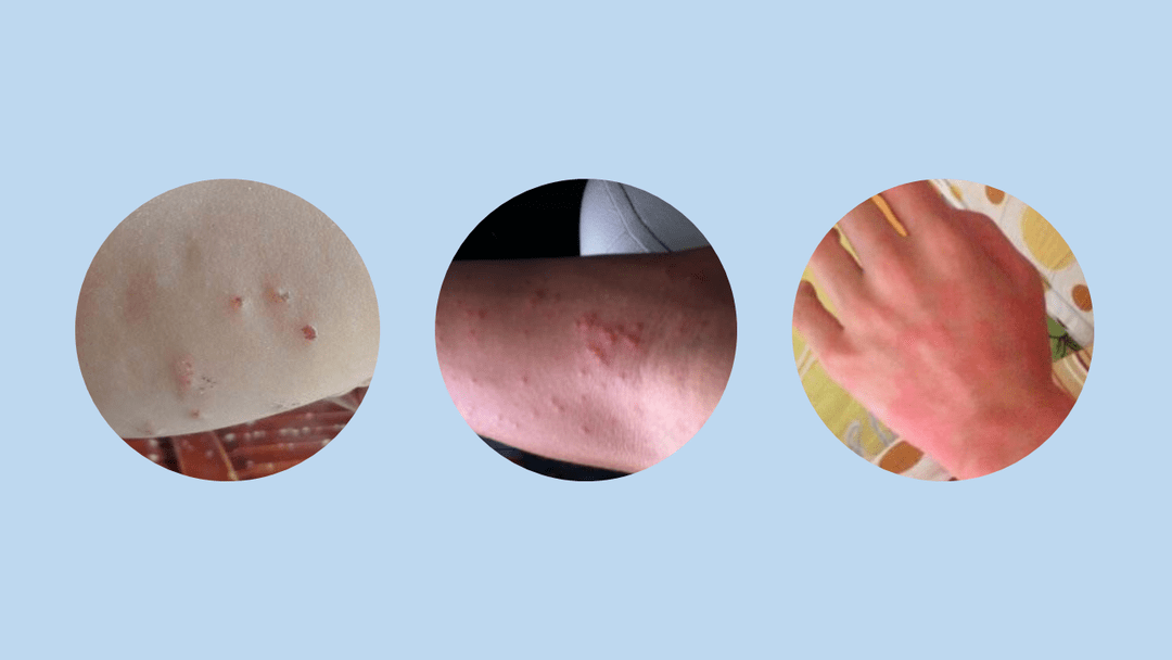 丘疹性荨麻疹  由昆虫叮咬后所致的一种过敏性皮肤病.